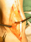 the approach to the joint, just lateral to tibialis anterior(1). the ankle joint is open and marked as 2.