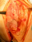 the distal tibia(1) and talus(2) more widely exposed. a large anterior spur of bone is visible from the tibia(3).