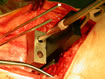 drilling the cylindrical lug holes to allow anchorage of the tibial component.