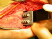 the tibial component being inserted.
